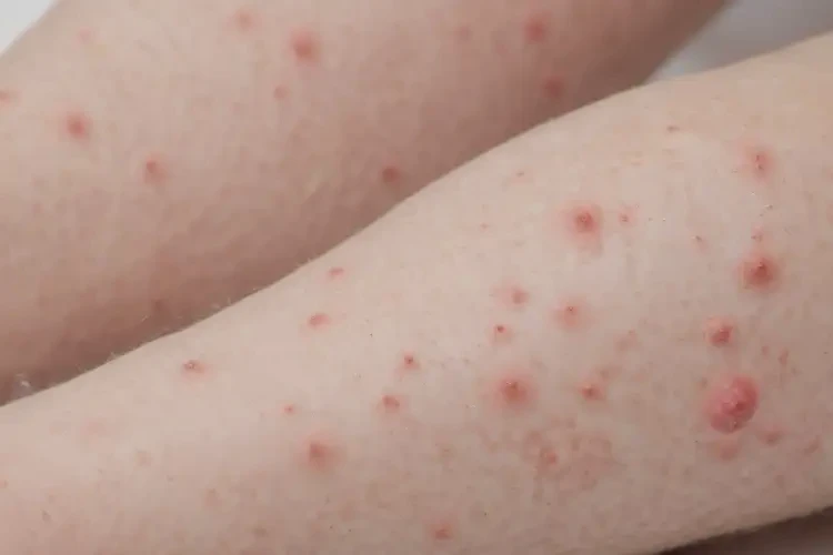 孩子四肢出現(xiàn)濕疹可不可以徹底自愈(圖4)