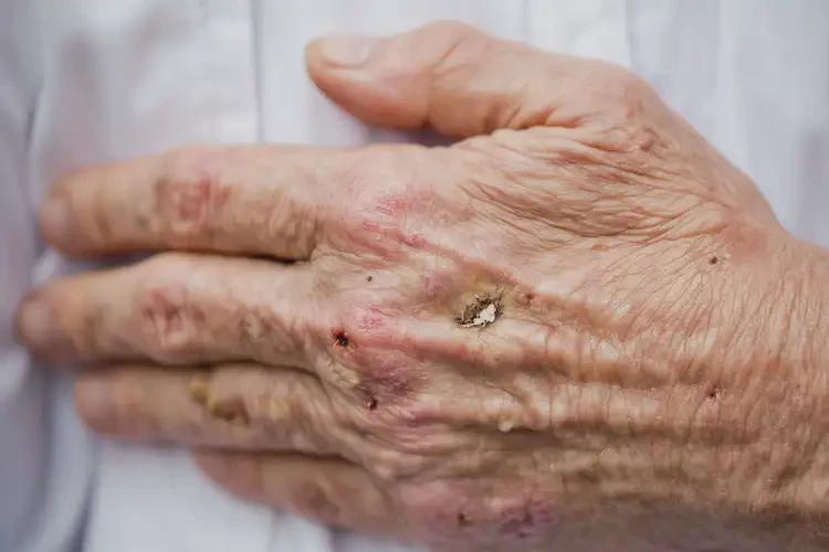 老年人手上出濕疹可以徹底自愈嗎(圖4)