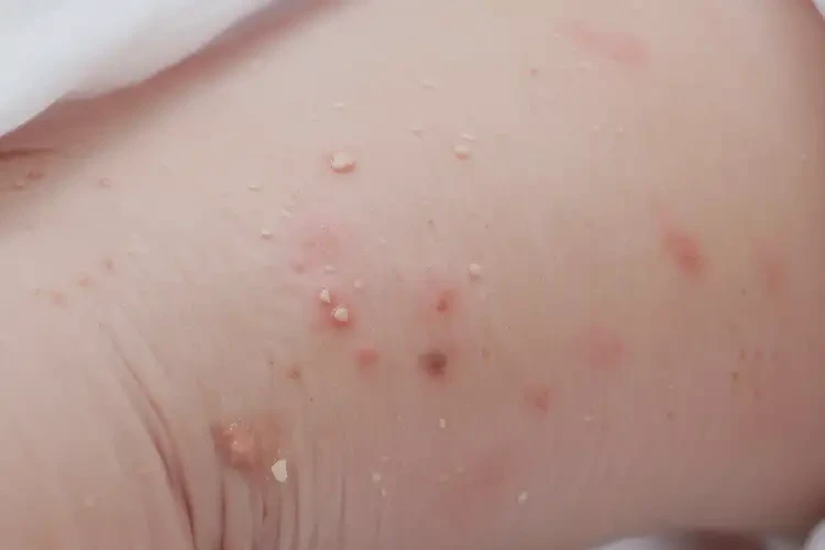 新生兒大腿容易起濕疹不管它會(huì)自己痊愈嗎(圖3)