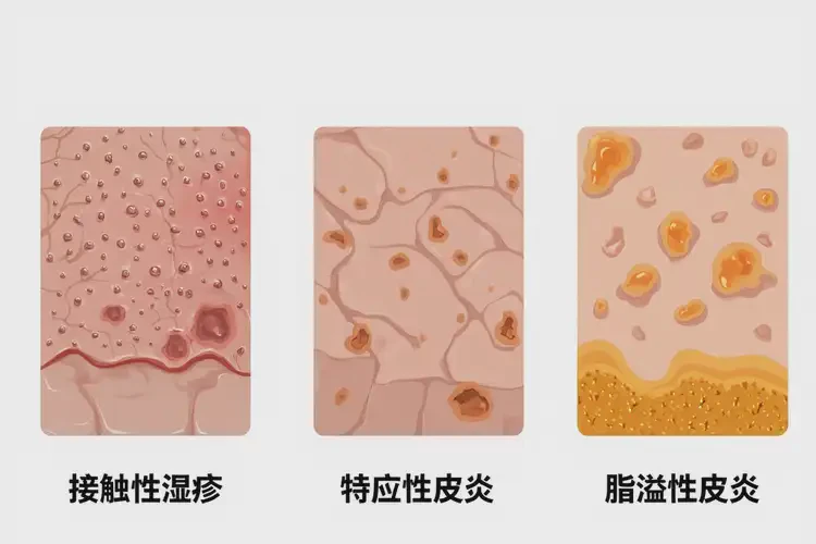 男人手臂經(jīng)常起濕疹能夠徹底治愈嗎(圖1)