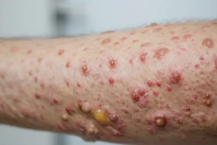 小學生四肢偶爾長濕疹不管它會自己好嗎(圖3)