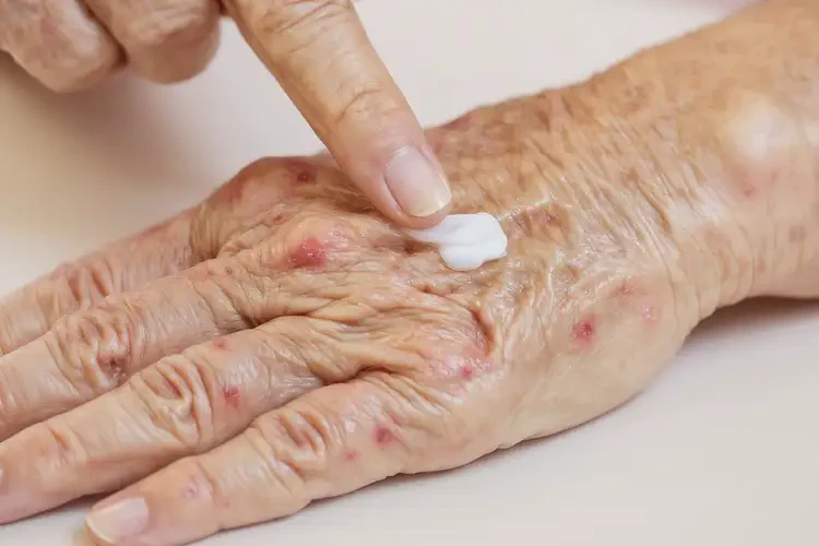 高齡老人手上容易起濕疹不管它會自己自愈嗎(圖3)