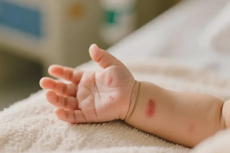 嬰兒手上經(jīng)常長濕疹不管它會(huì)自己好嗎(圖4)