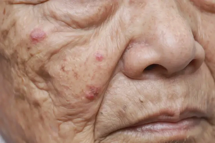 高齡老人脖子上容易長濕疹可以徹底自愈嗎(圖4)