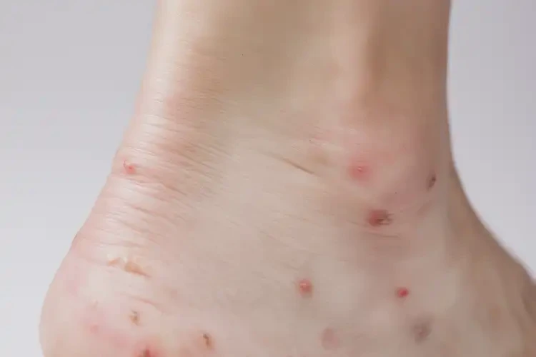 女生腳上偶爾起濕疹不管它會自己自愈嗎(圖2)