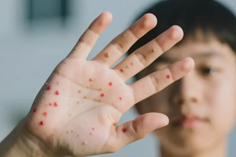 青年人手上偶爾起濕疹可不可以徹底自愈(圖1)