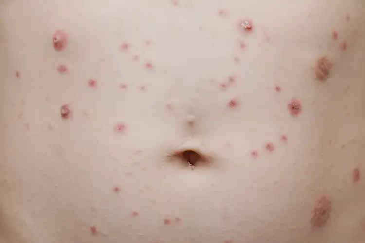 兒童肚子上出現(xiàn)濕疹能靠自己自愈嗎(圖4)