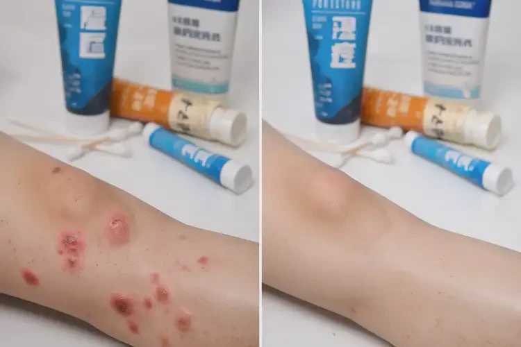小兒大腿上長(zhǎng)濕疹可不可以徹底自愈(圖1)