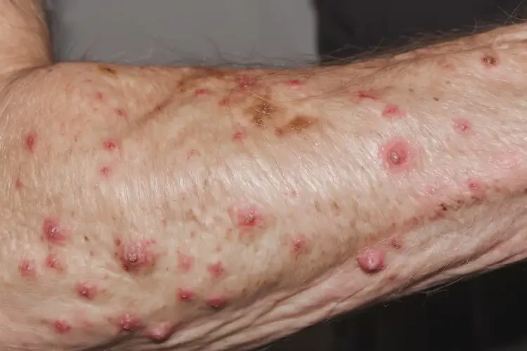 老年人四肢经常长湿疹不管它会自己痊愈吗(图4)