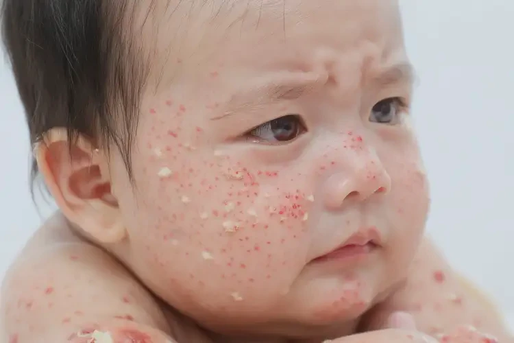 寶寶身上起濕疹能靠自己自愈嗎(圖4)