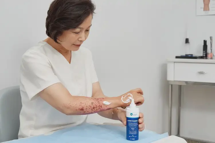 大學(xué)生屁股上起濕疹不管它會自己痊愈嗎(圖2)