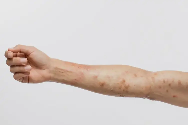 女生手臂上出现湿疹不管它会自己痊愈吗(图2)