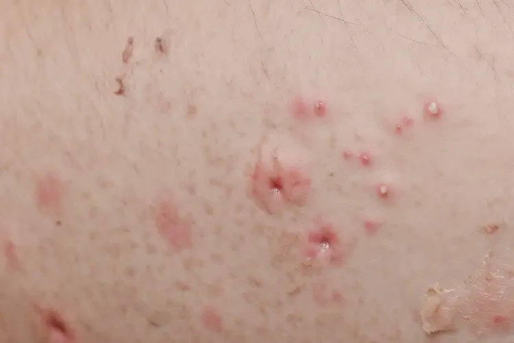 女性大腿出現(xiàn)濕疹能徹底自愈嗎(圖4)