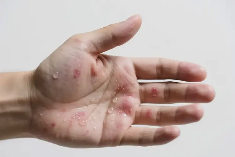 男性手上偶爾長濕疹不管它會自己痊愈嗎(圖1)
