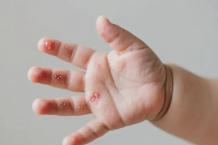 嬰兒手上長濕疹不管它會自己自愈嗎(圖2)