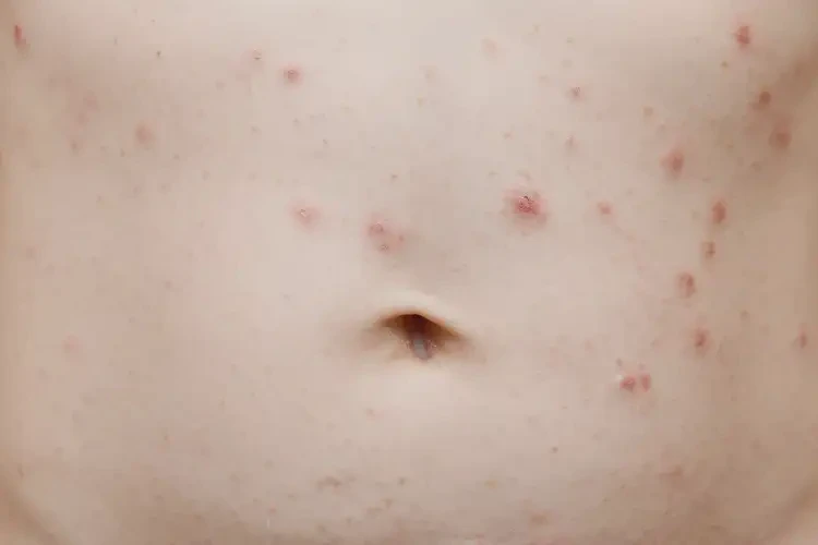 小學(xué)生肚子上經(jīng)常起濕疹不管它會(huì)自己好嗎(圖4)