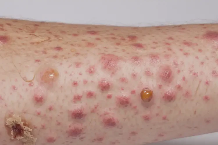 小學(xué)生肚子上經(jīng)常起濕疹不管它會(huì)自己好嗎(圖2)