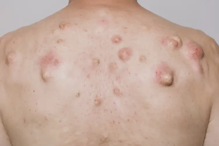 男人全身經(jīng)常長濕疹能徹底自愈嗎(圖4)