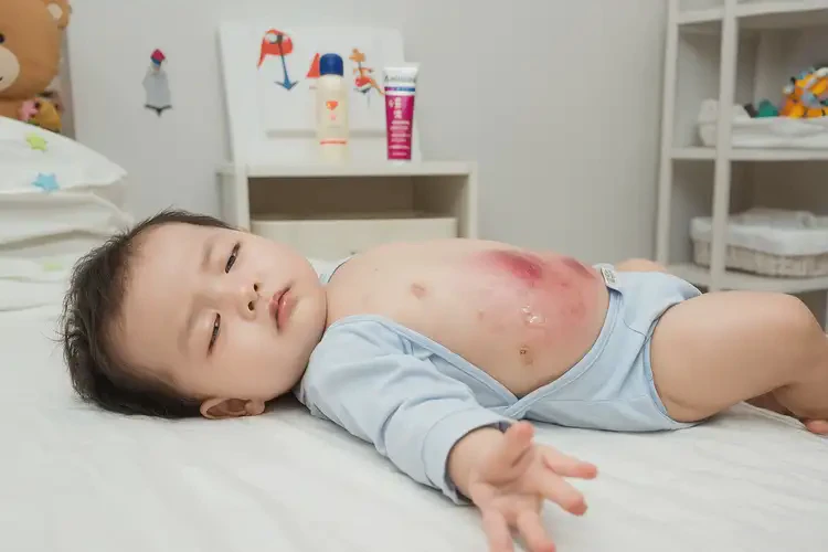 少兒肚子出濕疹能靠自己自愈嗎(圖3)