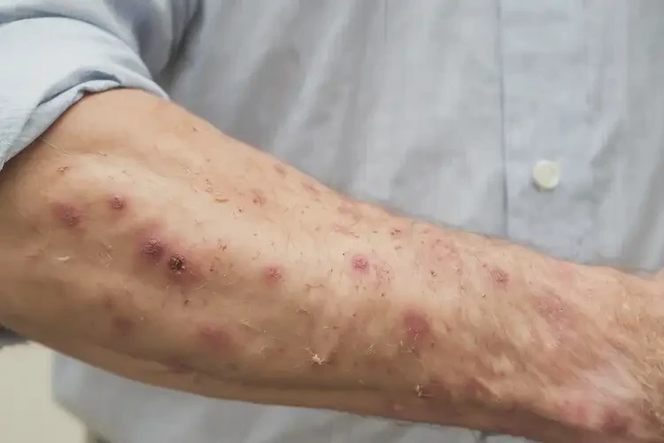 男性手臂起濕疹不管它會(huì)自己痊愈嗎(圖4)