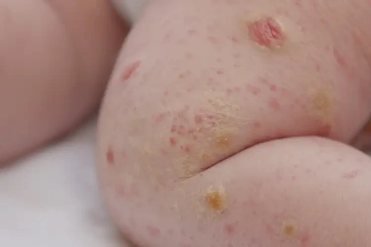 新生兒全身長濕疹能靠自己自愈嗎(圖4)
