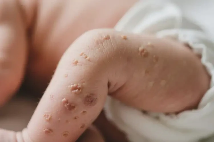 新生兒大腿偶爾起濕疹不管它會自己自愈嗎(圖4)