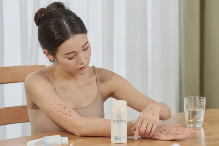 哺乳期媽媽手上容易長(zhǎng)濕疹不管它會(huì)自己痊愈嗎(圖3)