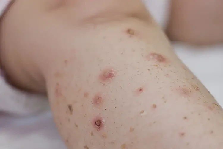 小孩小腿上經常長濕疹不管它會自己自愈嗎(圖4)