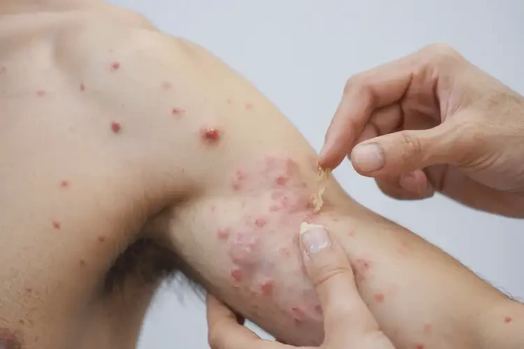 男生手臂上長濕疹不管它會自己痊愈嗎(圖4)