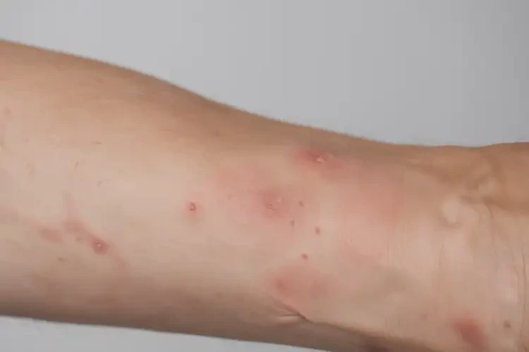 女生手臂上出现湿疹不管它会自己痊愈吗(图4)