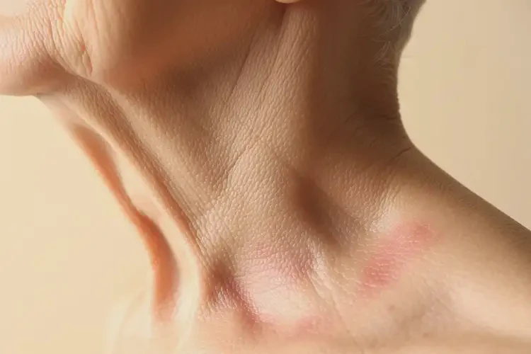 老人脖子上偶爾起濕疹能徹底自愈嗎(圖4)