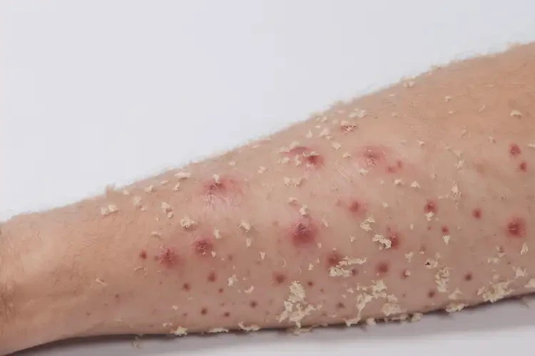 寶寶大腿出現(xiàn)濕疹可以徹底自愈嗎(圖2)