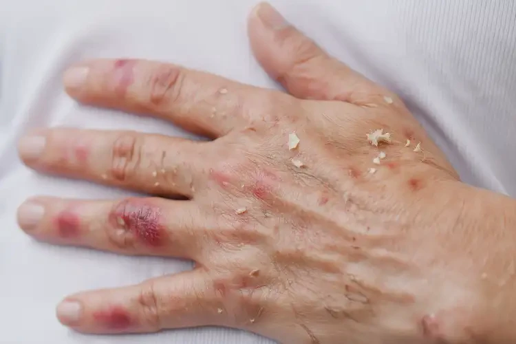女性手上容易起濕疹可以徹底自愈嗎(圖4)