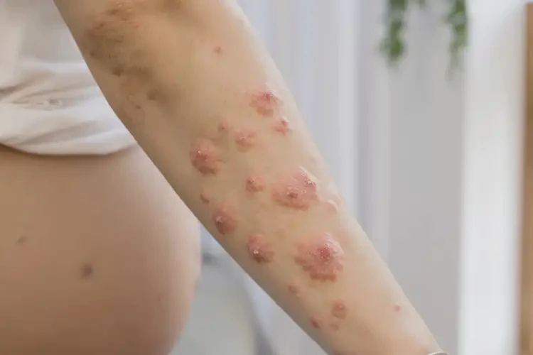 孕婦手臂上長濕疹能徹底自愈嗎(圖4)