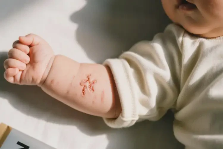 小兒手臂容易長濕疹不管它會(huì)自己好嗎(圖2)