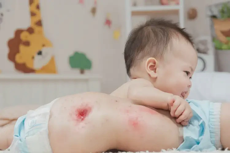 孩子屁股上有濕疹能夠徹底治愈嗎(圖4)