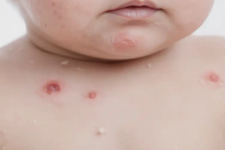 嬰幼兒脖子長濕疹不管它會自己痊愈嗎(圖4)