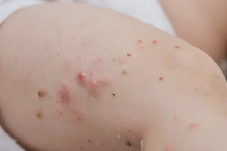 婴幼儿小腿容易起湿疹不管它会自己痊愈吗(图4)