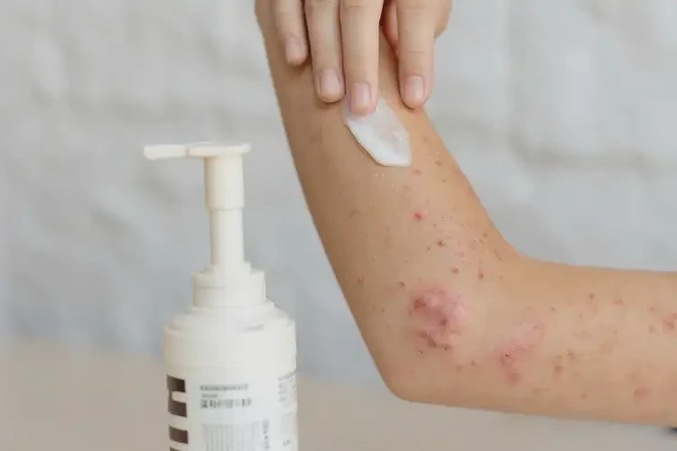 大學(xué)生手上偶爾長濕疹能不能徹底自愈(圖3)