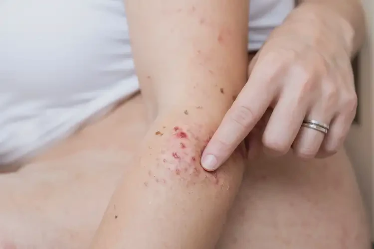 孕婦屁股上經常起濕疹不管它會自己自愈嗎(圖4)