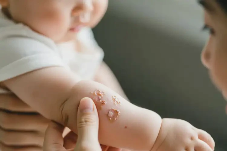 幼兒手臂有濕疹不管它會(huì)自己痊愈嗎(圖2)