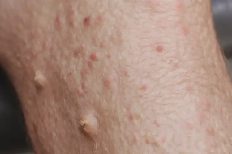 老年人小腿偶爾長(zhǎng)濕疹能靠自己自愈嗎(圖4)