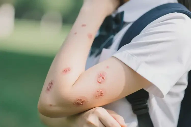 大學生手臂偶爾起濕疹不管它會自己痊愈嗎(圖1)