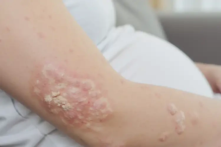 孕婦手臂上容易起濕疹不管它會自己好嗎(圖4)