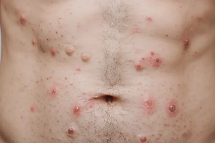 男人肚子出現(xiàn)濕疹能夠徹底治愈嗎(圖4)