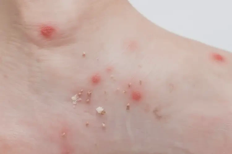 兒童腳上經(jīng)常長(zhǎng)濕疹不管它會(huì)自己自愈嗎(圖4)