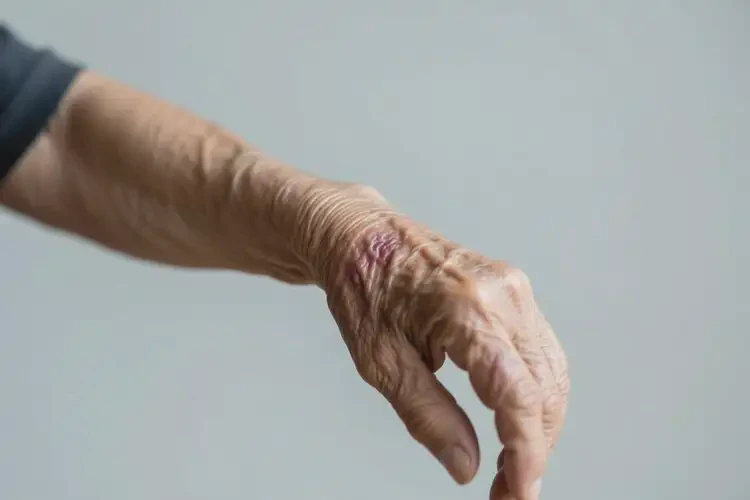 老人手臂出現(xiàn)濕疹不管它會(huì)自己好嗎(圖3)