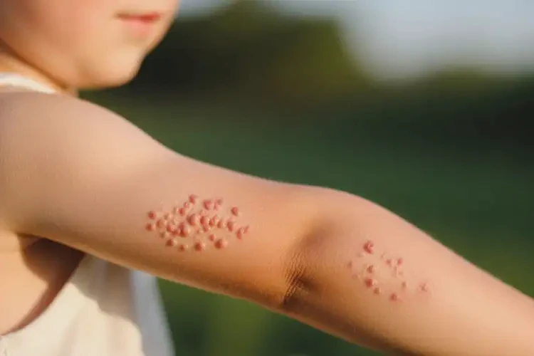 少儿身上长湿疹不管它会自己痊愈吗(图4)