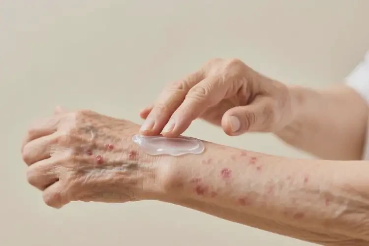 老年人手臂偶爾長(zhǎng)濕疹可不可以徹底自愈(圖4)