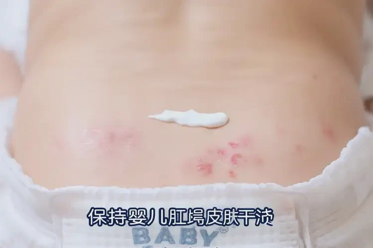 嬰兒肛周偶爾起濕疹可以徹底自愈嗎(圖3)